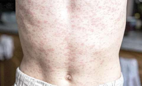 Alertan médicos sobre brote de sarampión en la zona conurbada Xalapa -Tlalnelhuayocan