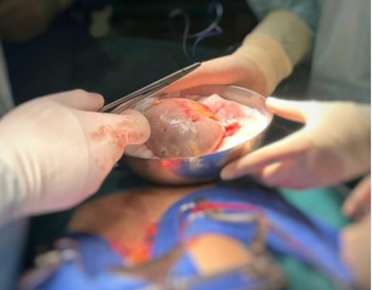 Unos 800 veracruzanos en espera de un riñón y 80, por una córnea